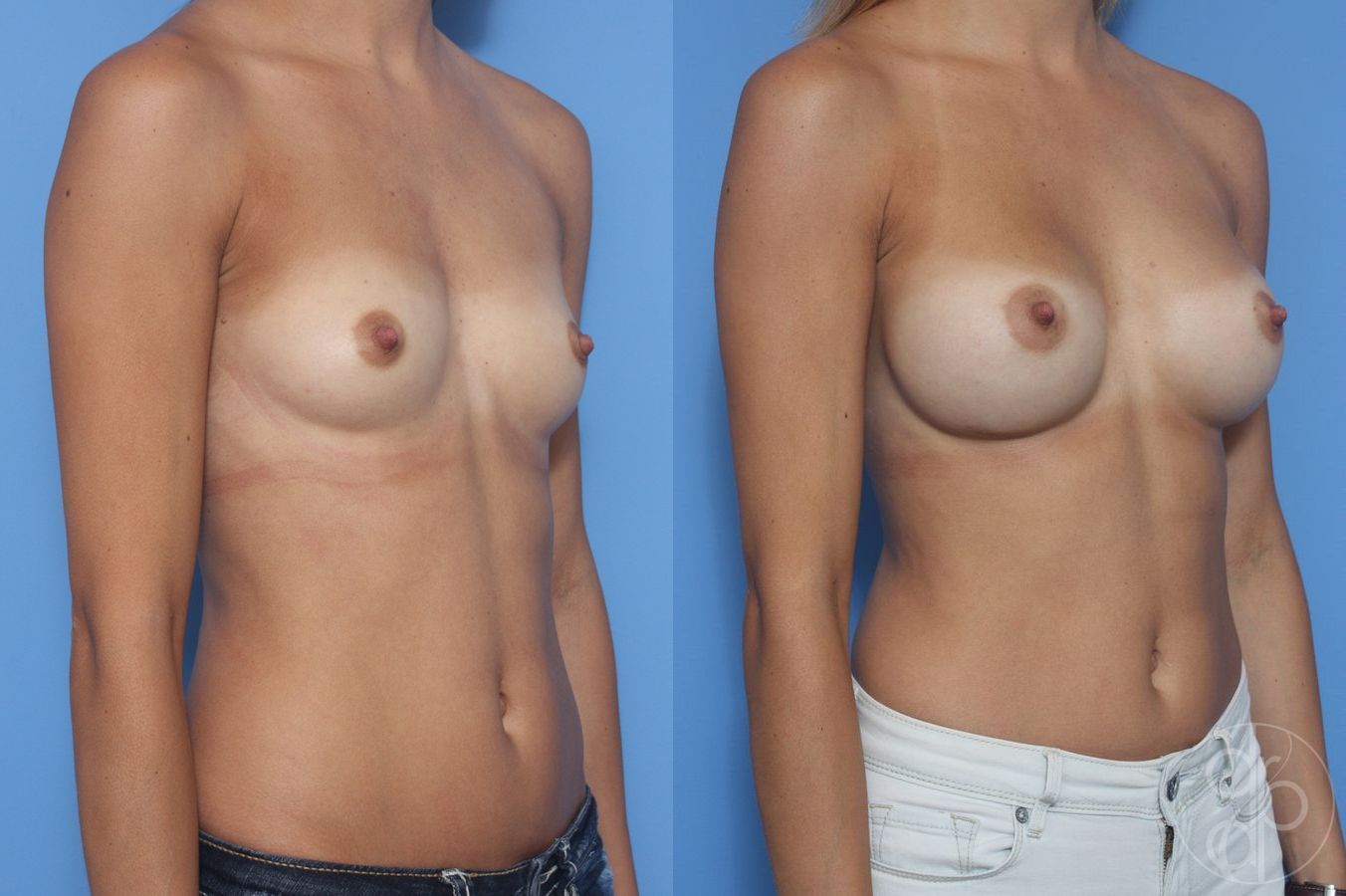 Before and after Breast Augmentation case 29951 - Angle 2