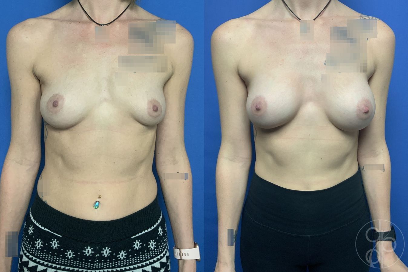 Before and after Breast Augmentation case 29877