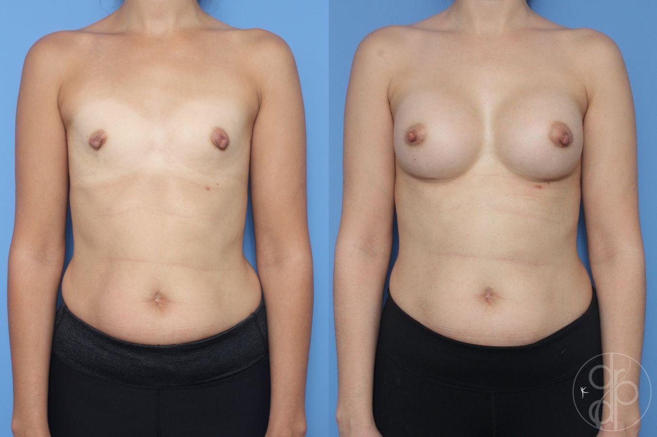 Breast Augmentation - Case 389