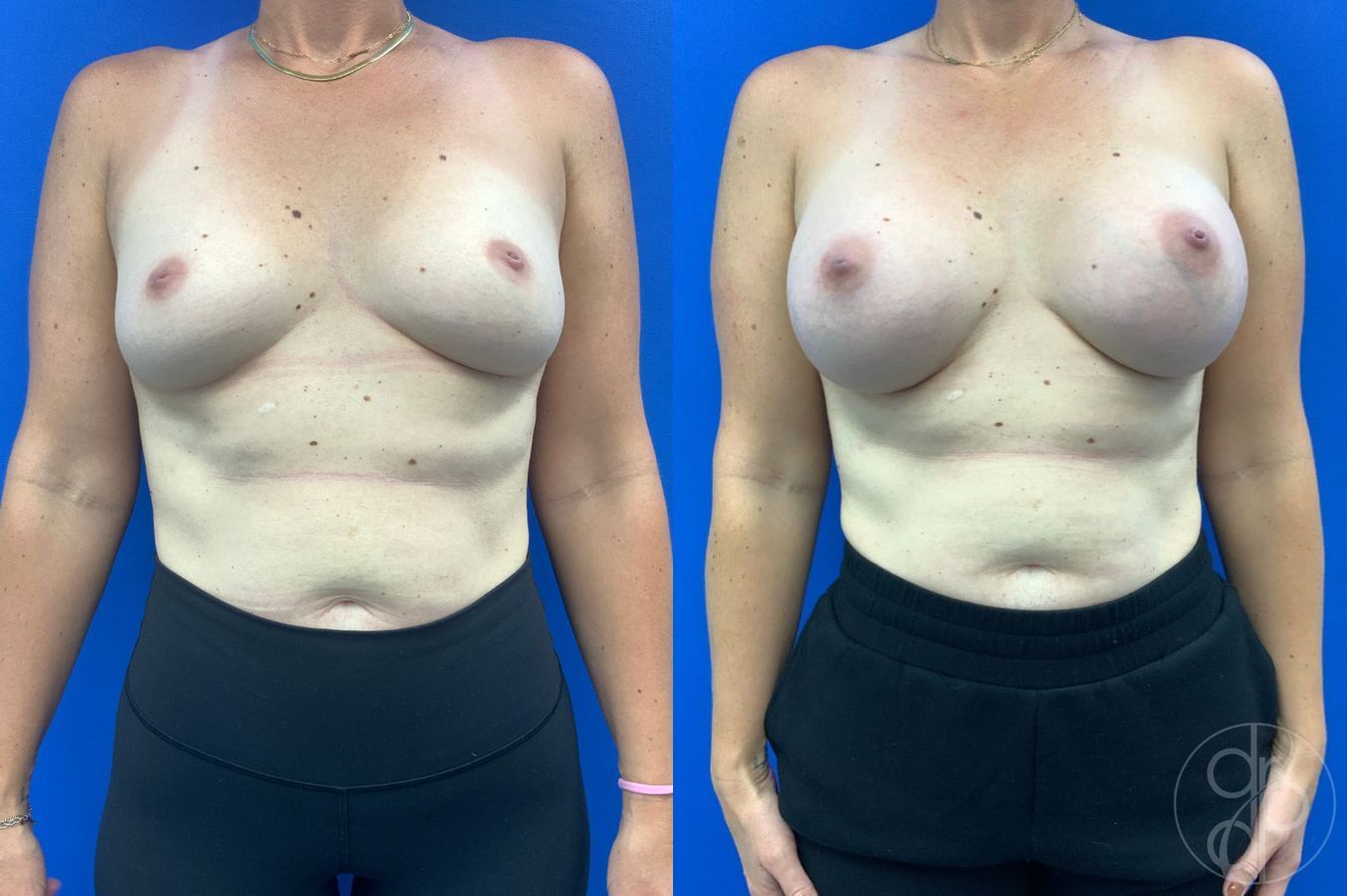 Before and after Breast Augmentation case 46263