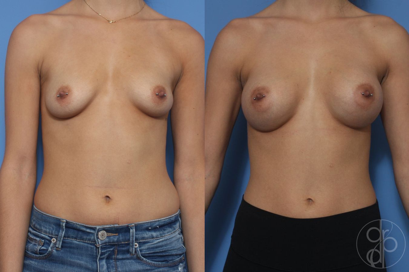 Before and after Breast Augmentation case 29944