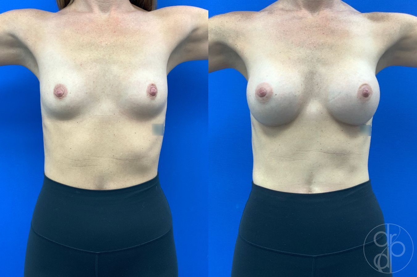 Before and after Breast Augmentation case 46252 - Angle 2