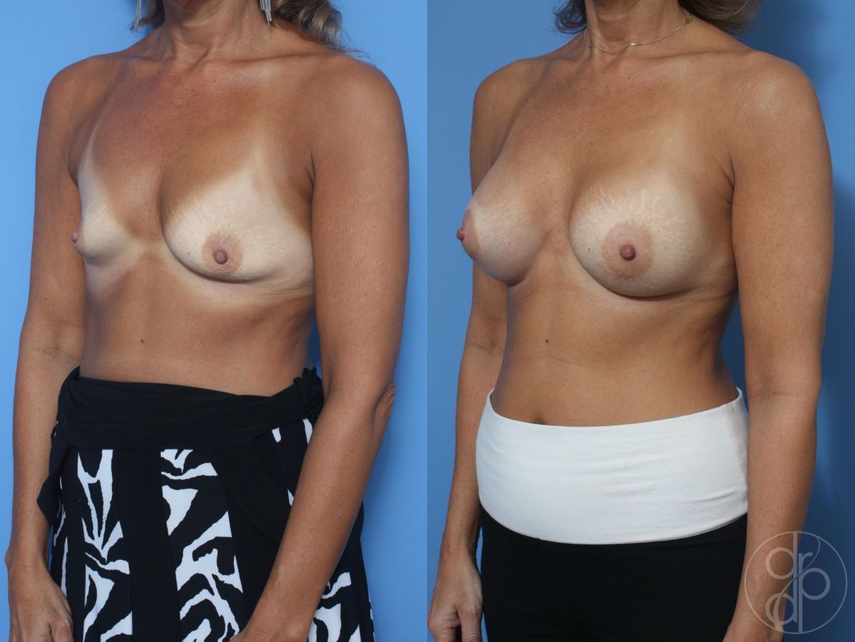Before and after Breast Augmentation case 29823 - Angle 4