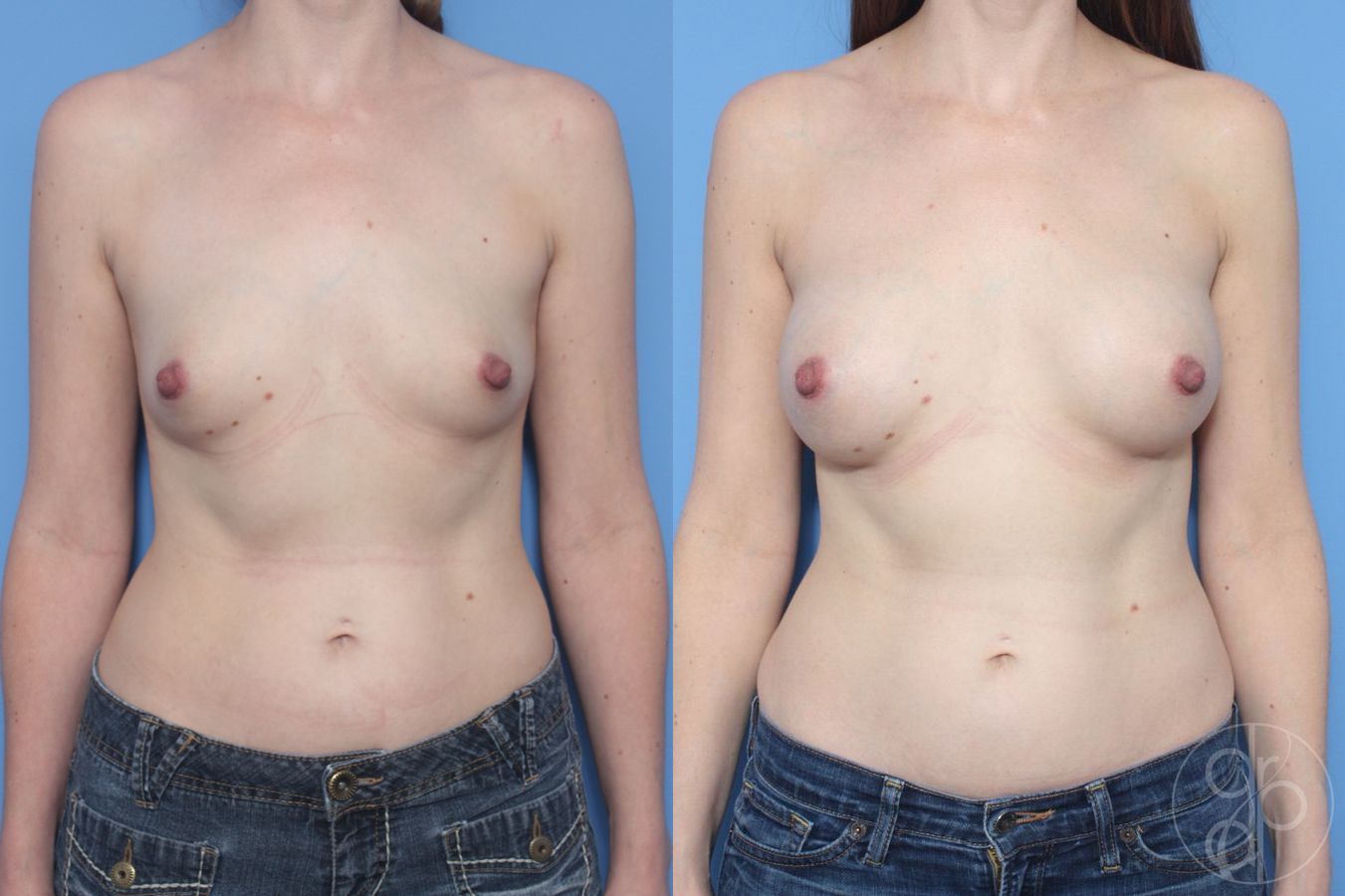 Before and after Breast Augmentation case 29950