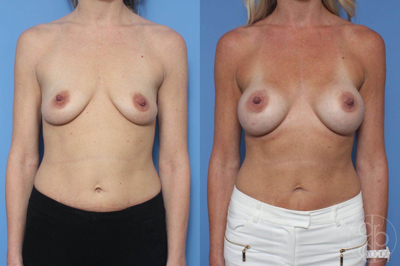 Before and after Breast Augmentation case 29938