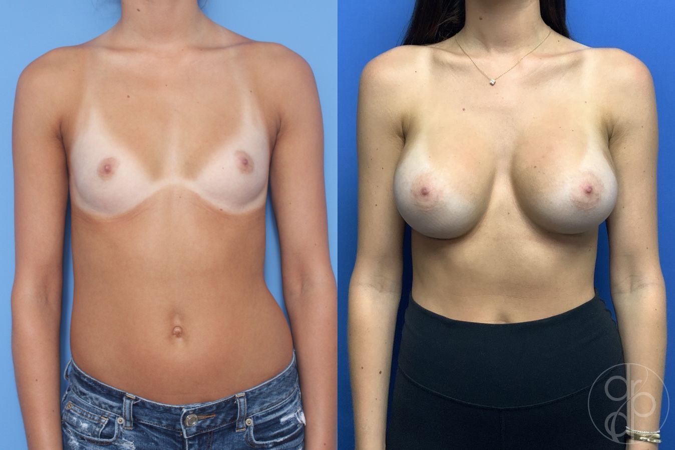 Before and after Breast Augmentation case 29974
