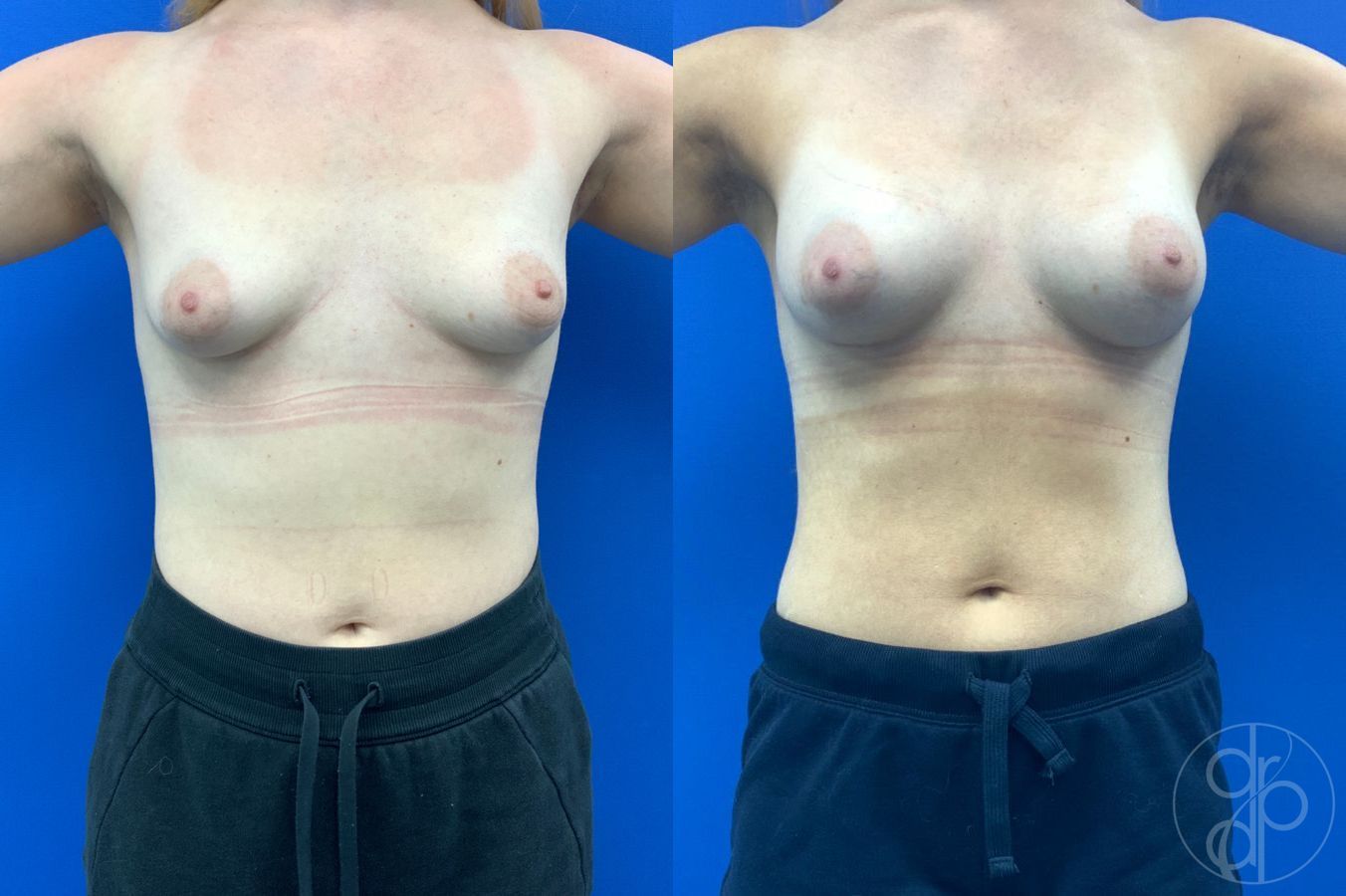 Before and after Tubular Breast Surgery case 46765 - Angle 2