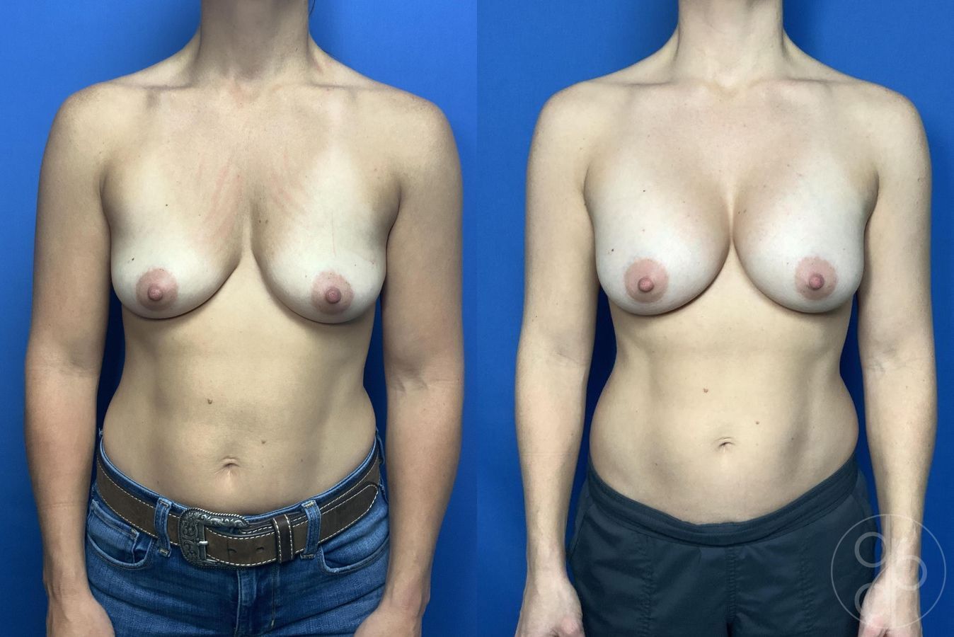 Before and after Breast Augmentation case 29988
