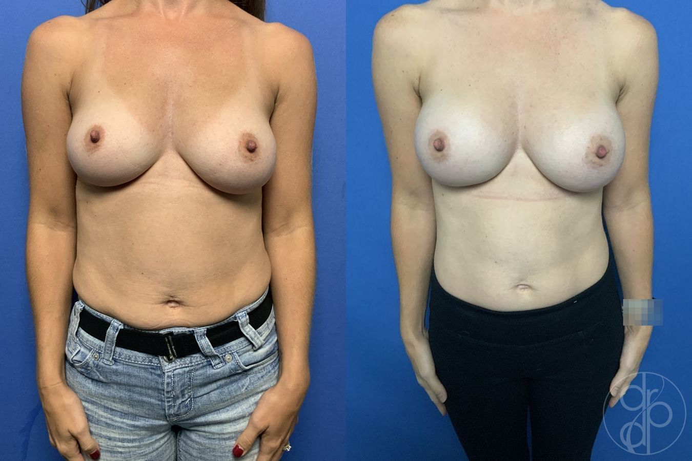 Before and after Breast Augmentation case 29830