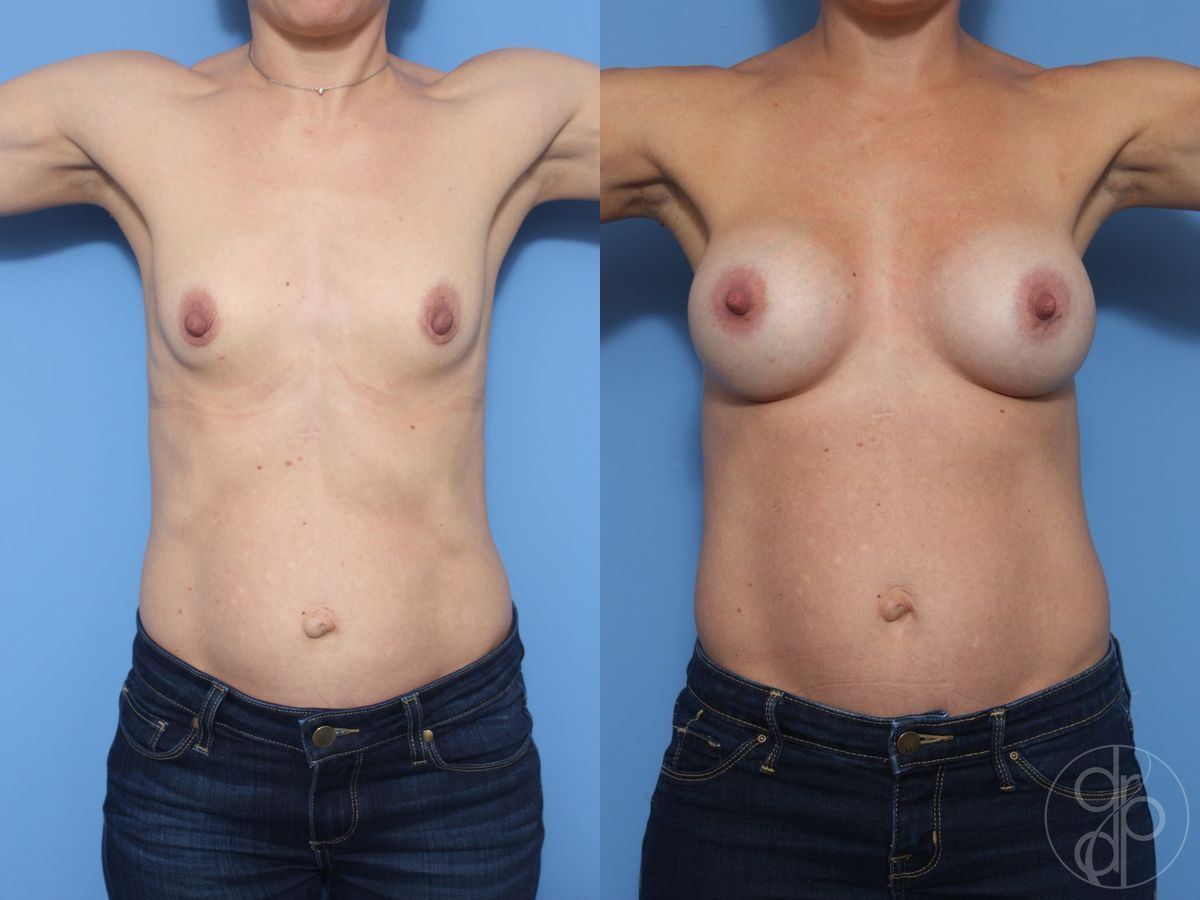 Breast Augmentation - Thumbnail 2