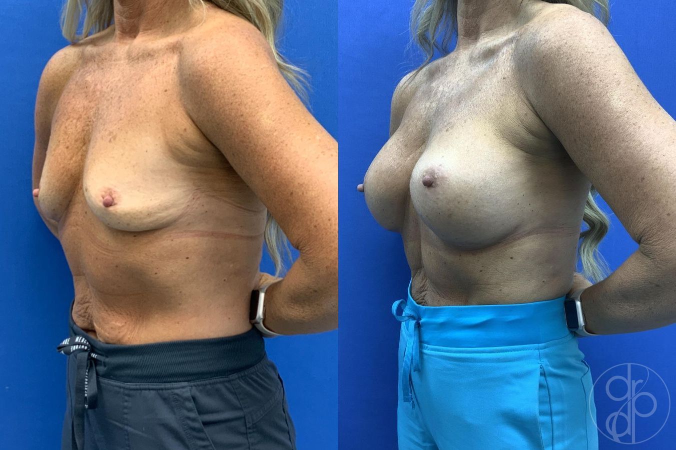 Before and after Breast Augmentation case 29657 - Angle 3