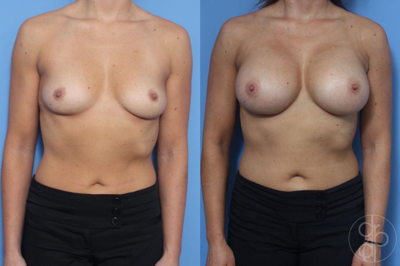 Before and after Breast Augmentation case 29947