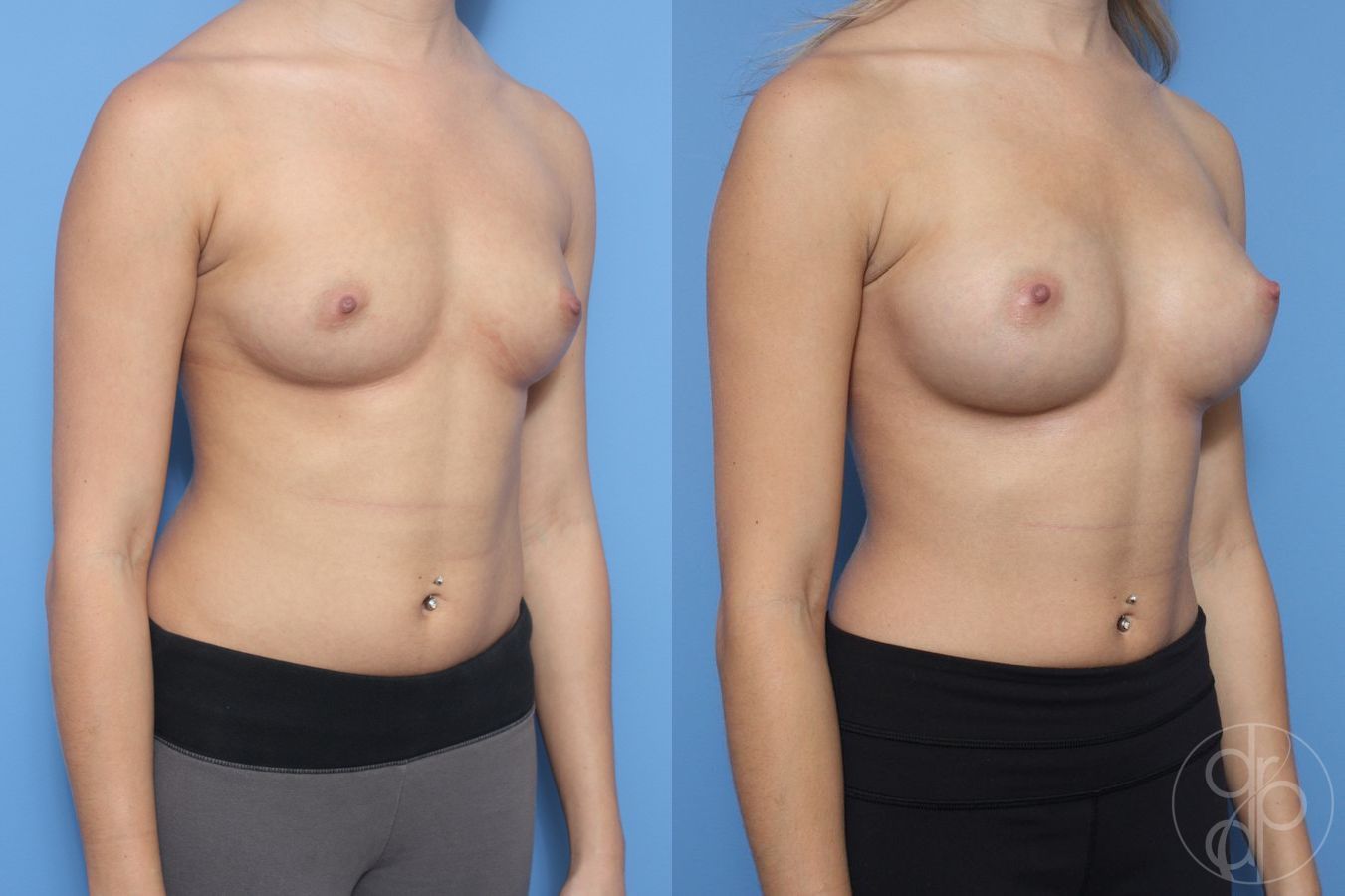 Before and after Breast Augmentation case 29908 - Angle 2