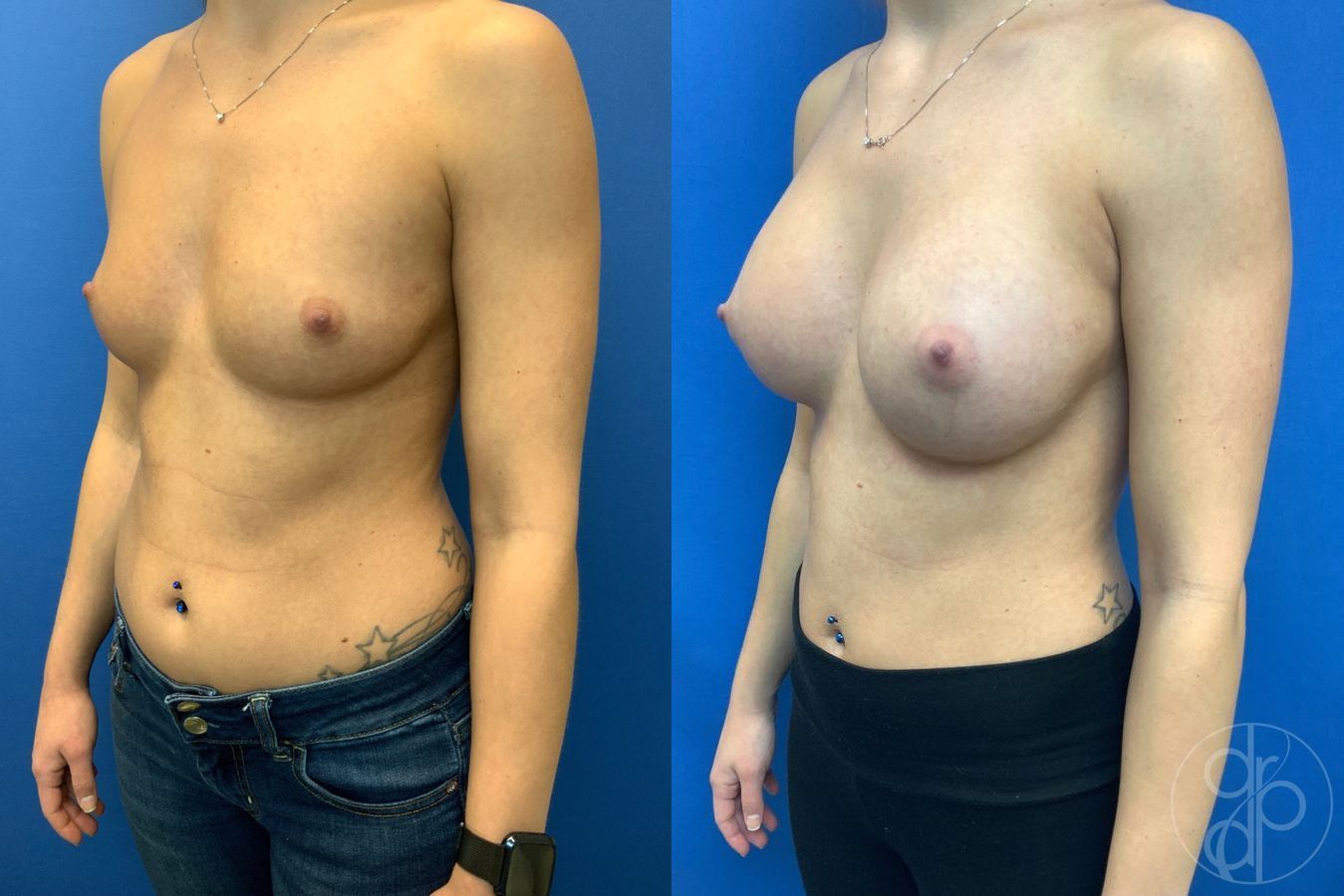 Before and after Breast Augmentation case 29943 - Angle 3