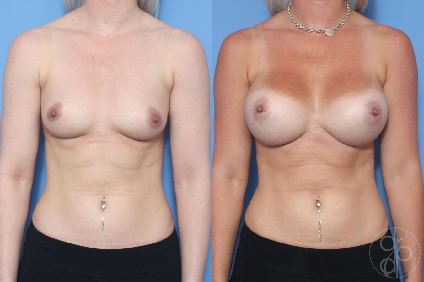 Before and after procedure result