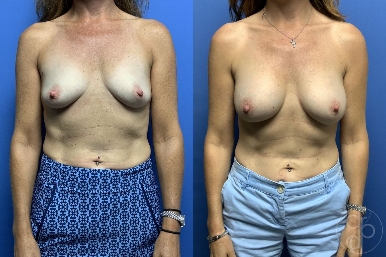 Before and after Breast Augmentation case 29792