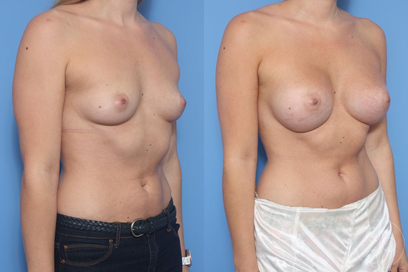 Before and after Breast Augmentation case 29913 - Angle 2