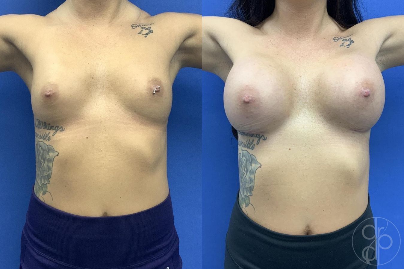 Before and after Breast Augmentation case 29606 - Angle 2