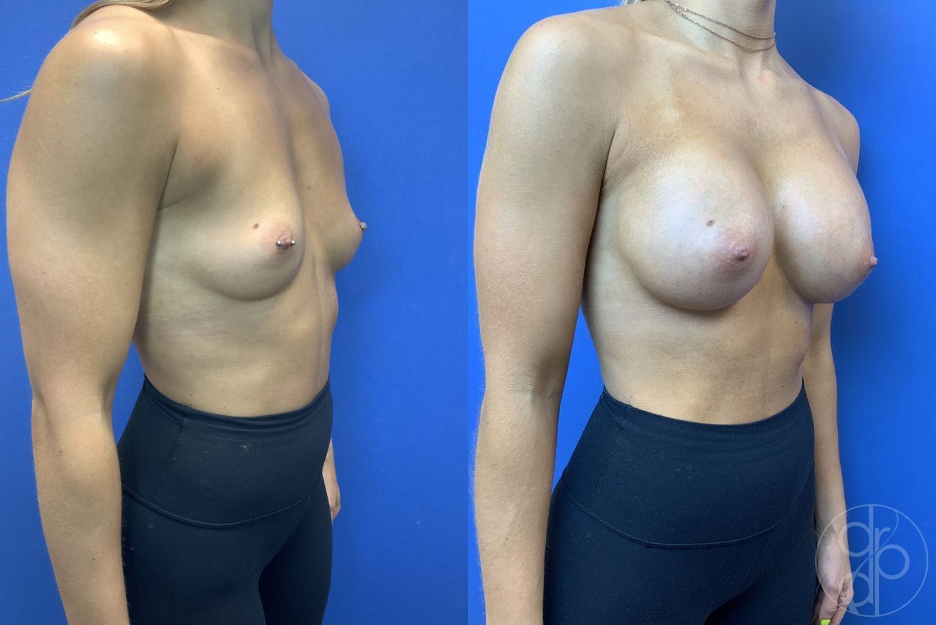 Before and after Breast Augmentation case 29941 - Angle 2