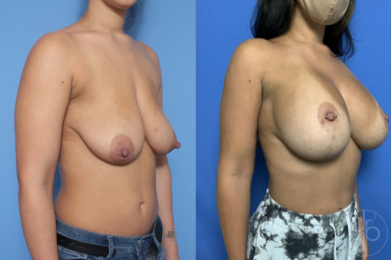 Breast Augmentation with Lift - Thumbnail 3