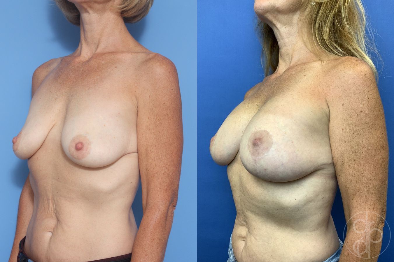 Breast Augmentation with Lift - Thumbnail 2
