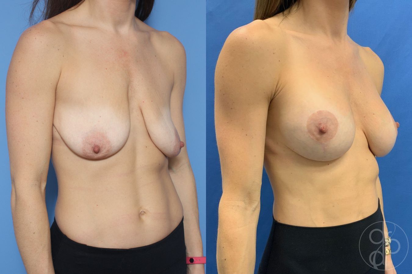 Before and after Breast Augmentation with Lift case 29866 - Angle 2