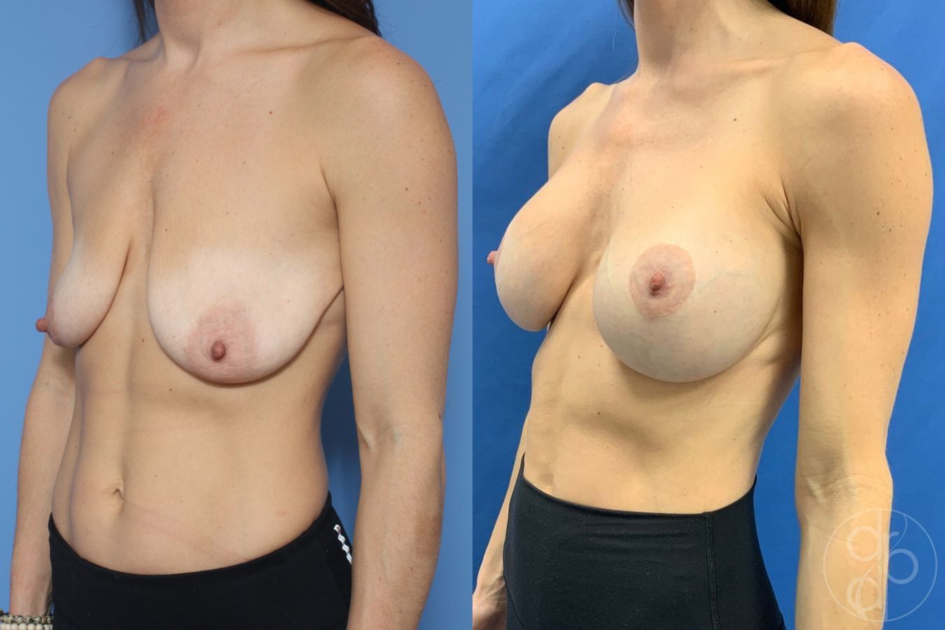 Before and after Breast Augmentation with Lift case 29866 - Angle 3