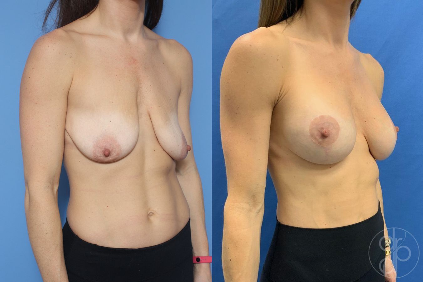Breast Augmentation with Lift - Thumbnail 2