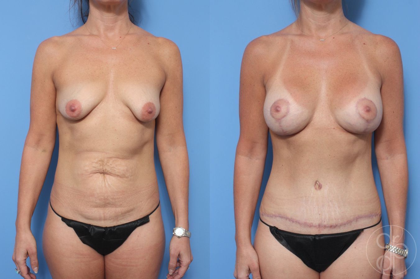 Before and after Breast Augmentation with Lift case 29717