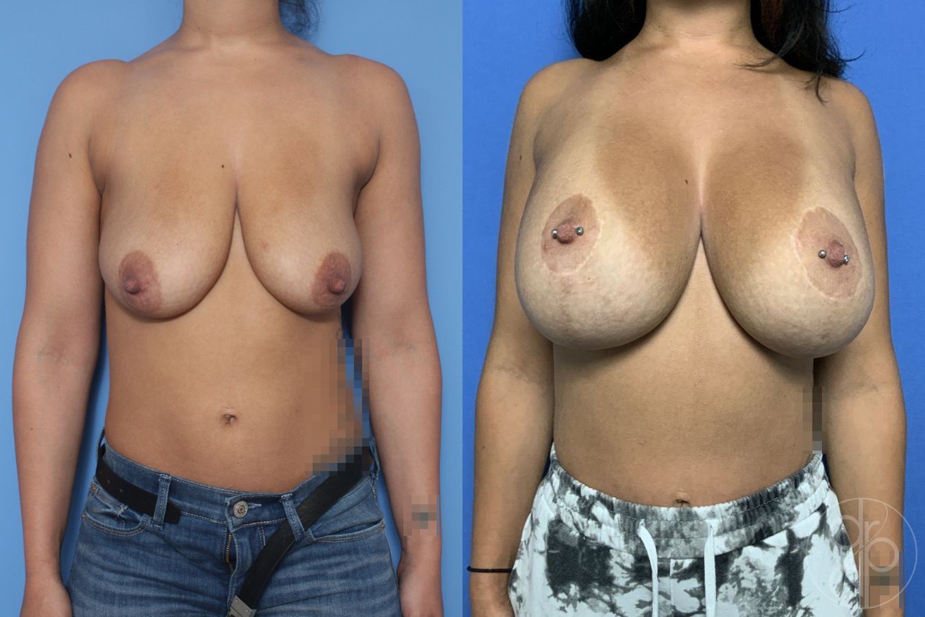 Before and after Breast Augmentation with Lift case 29868