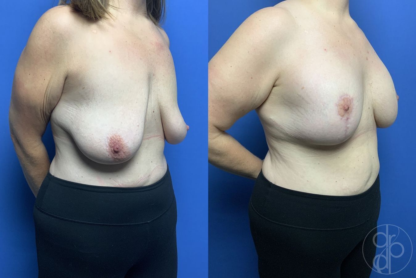 Before and after Breast Augmentation with Lift case 29870 - Angle 3