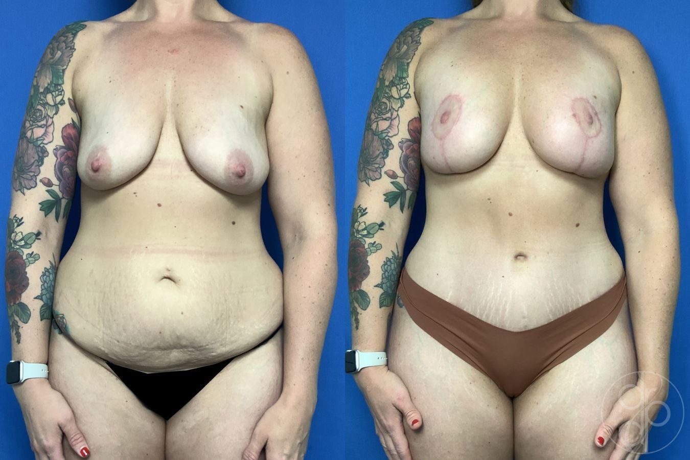 Before and after Breast Augmentation with Lift case 29735