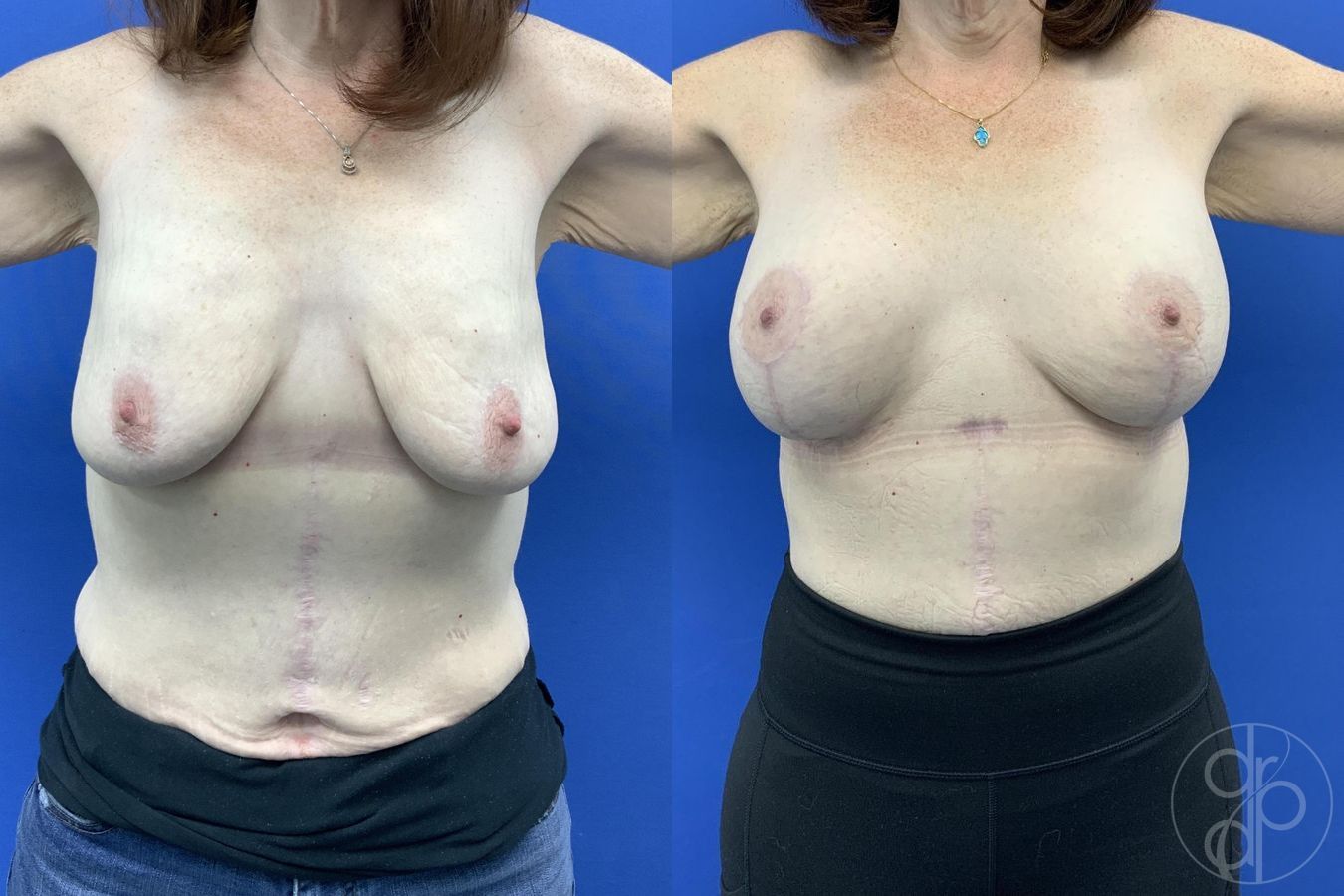 Before and after Breast Augmentation with Lift case 30017 - Angle 2