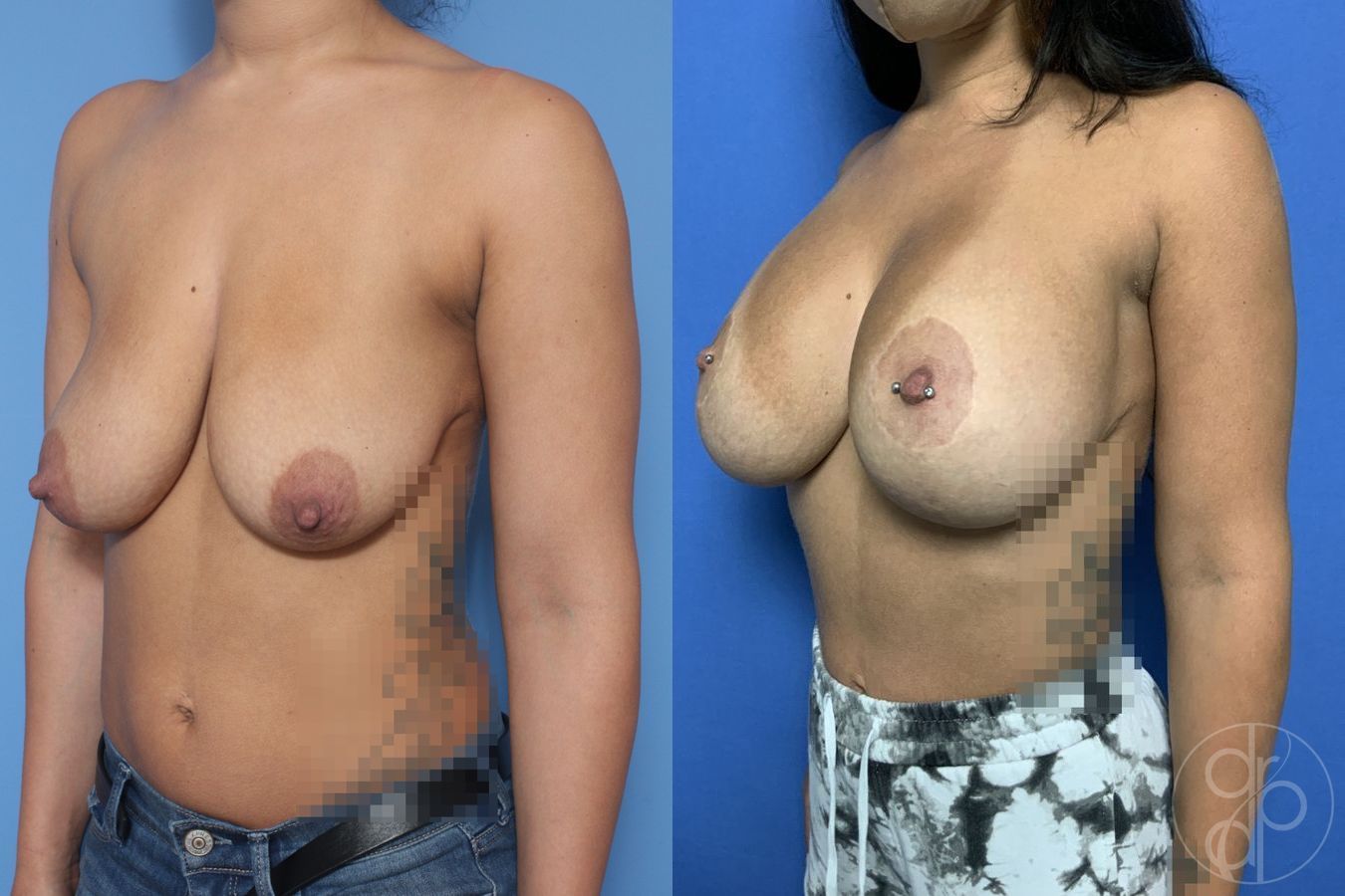 Before and after Breast Augmentation with Lift case 29868 - Angle 2
