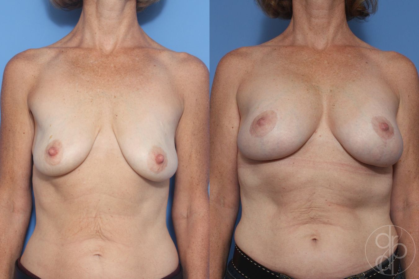 Before and after Breast Augmentation with Lift case 29869
