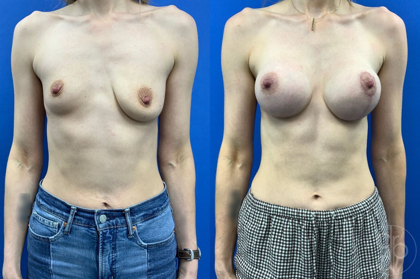 Before and after Breast Augmentation case 46255