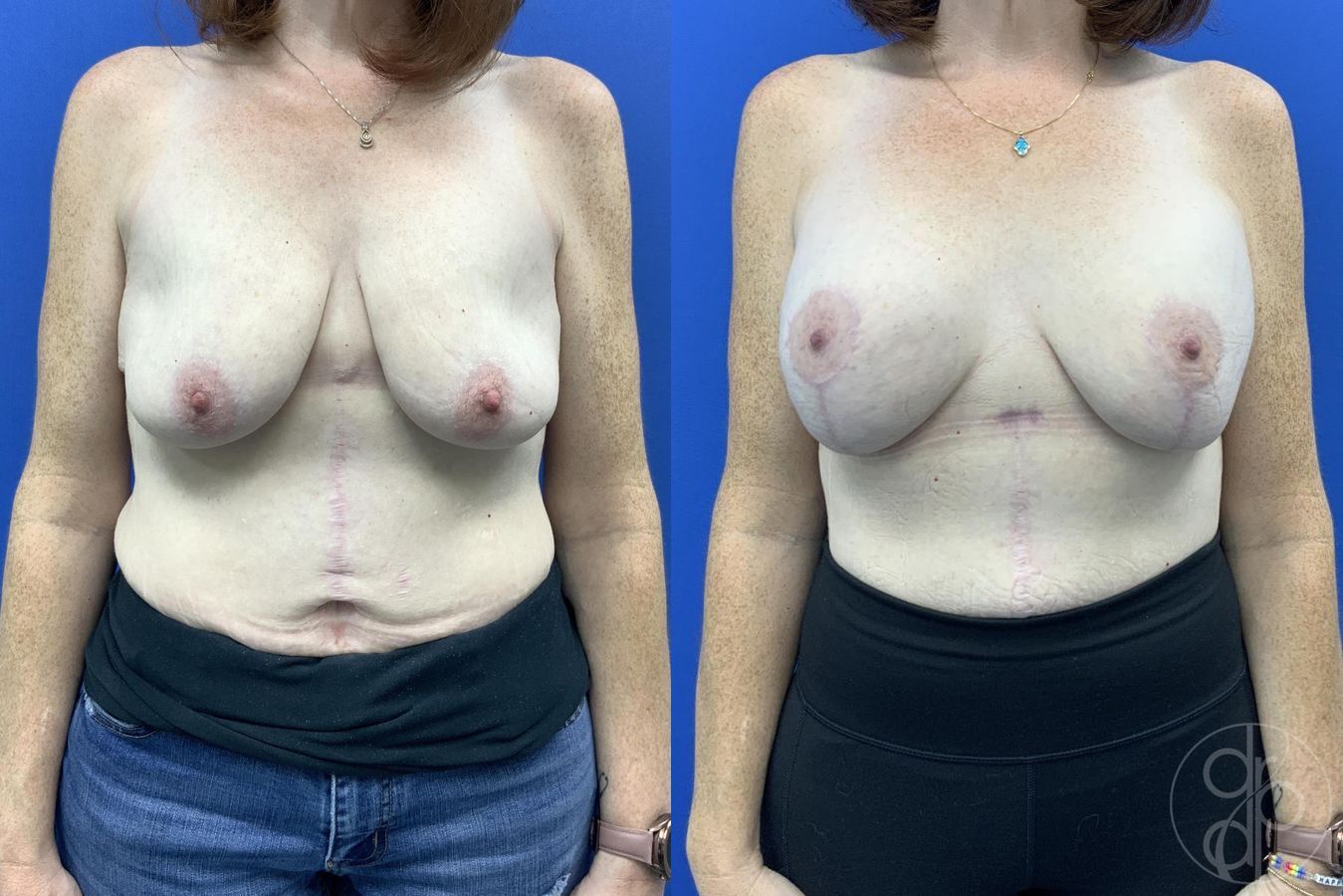 Breast Augmentation with Lift - Case 472