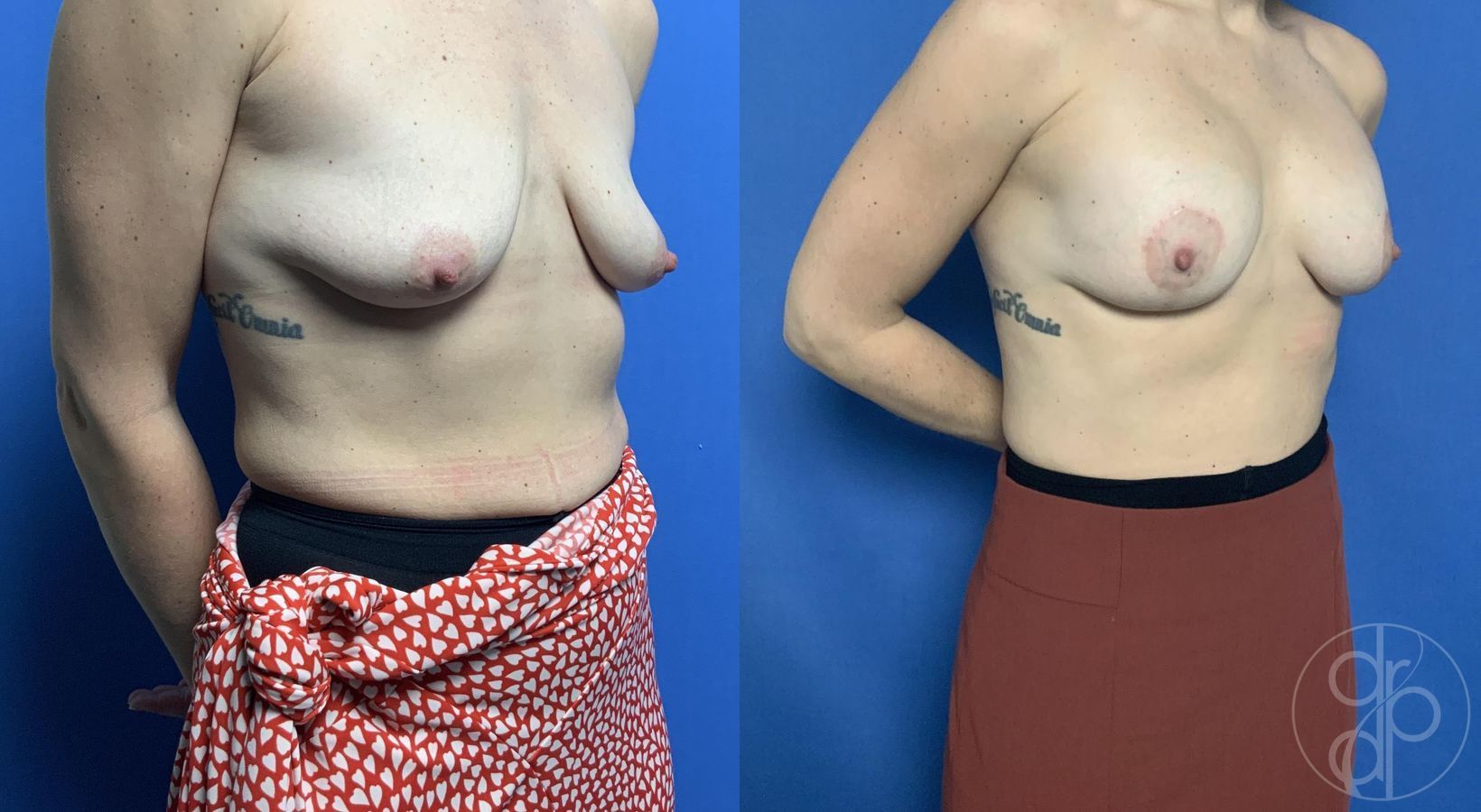 Before and after Breast Augmentation with Lift case 29799 - Angle 2