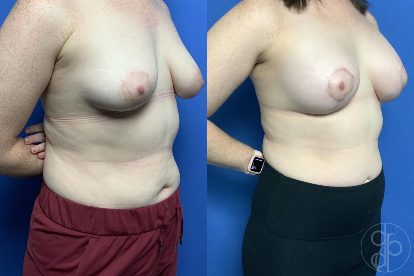 Before and after Breast Augmentation with Lift case 29782 - Angle 2