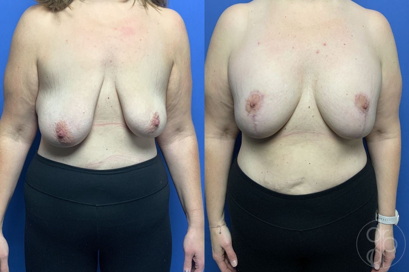 Before and after Breast Augmentation with Lift case 29870