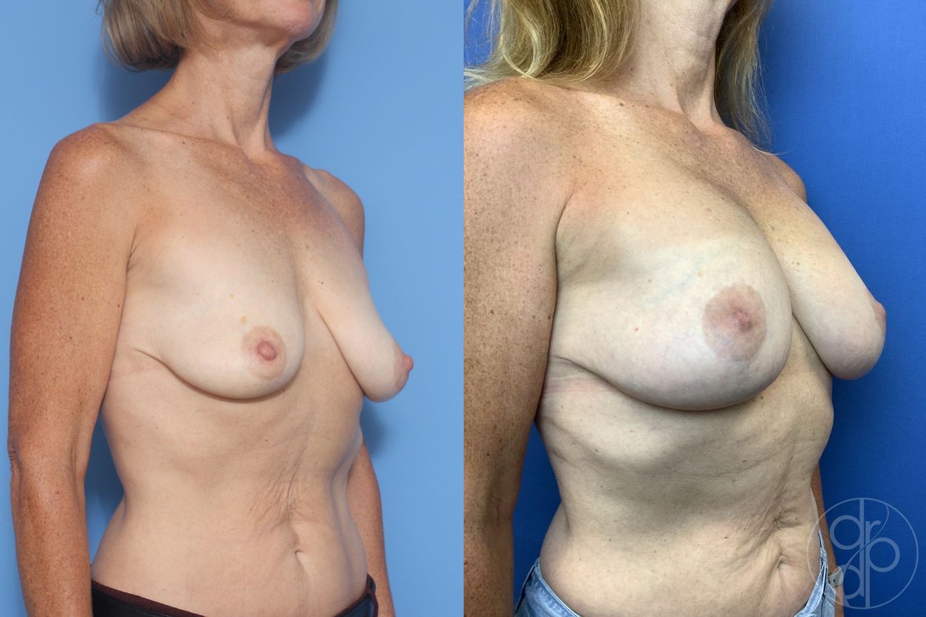 Breast Augmentation with Lift - Thumbnail 3