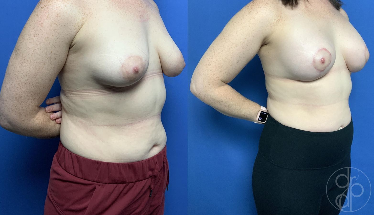 Breast Augmentation with Lift - Thumbnail 2