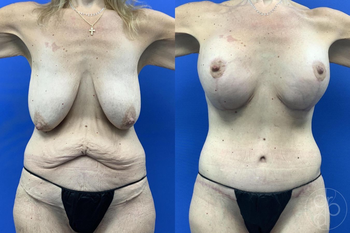 Before and after Breast Augmentation with Lift case 29629 - Angle 2