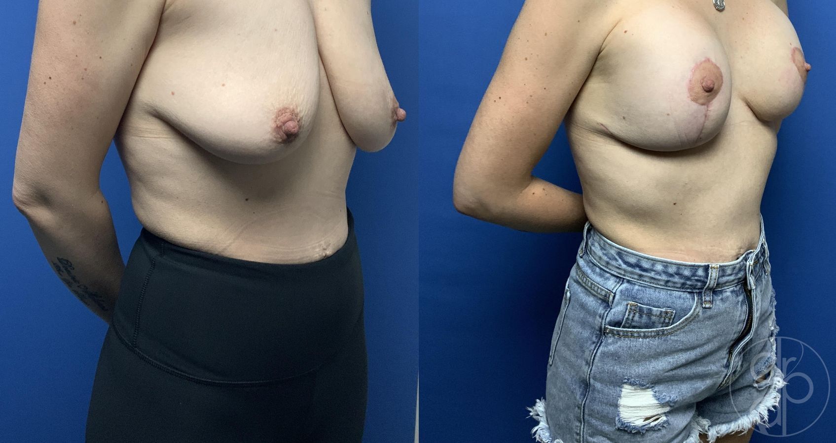 Breast Augmentation with Lift - Thumbnail 3