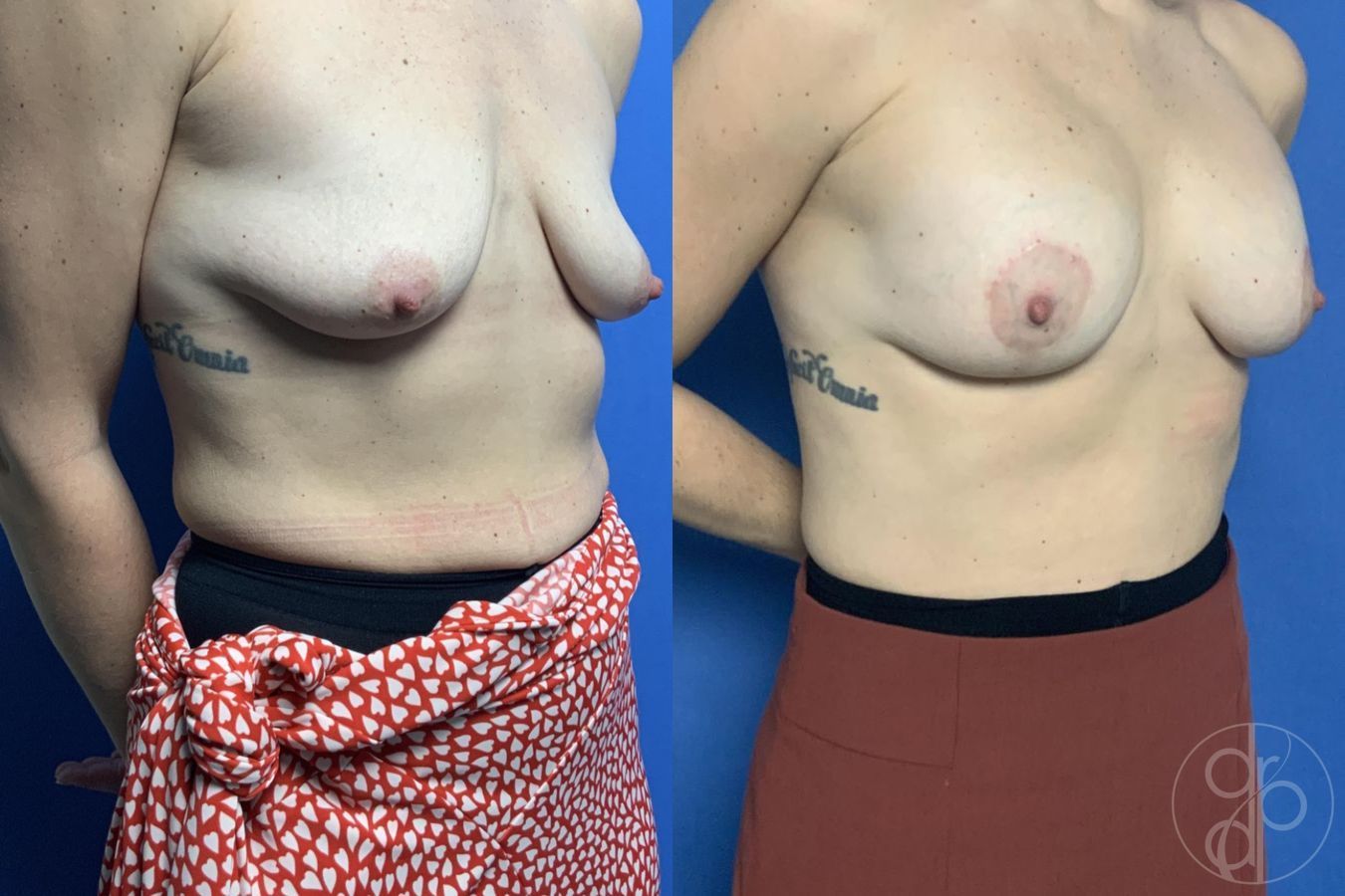 Before and after Breast Augmentation with Lift case 29799 - Angle 2