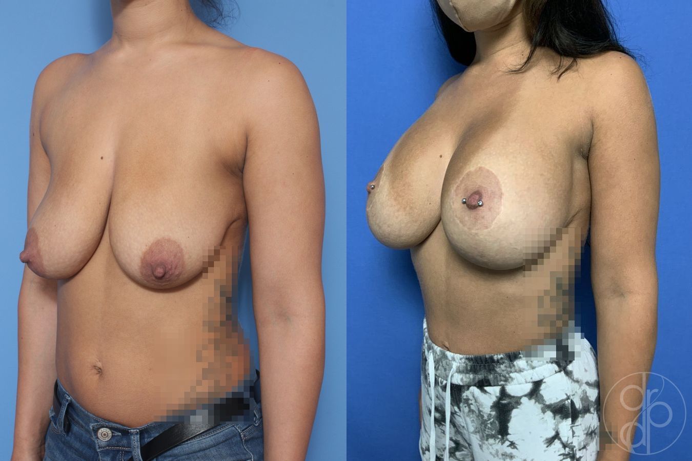 Breast Augmentation with Lift - Thumbnail 2