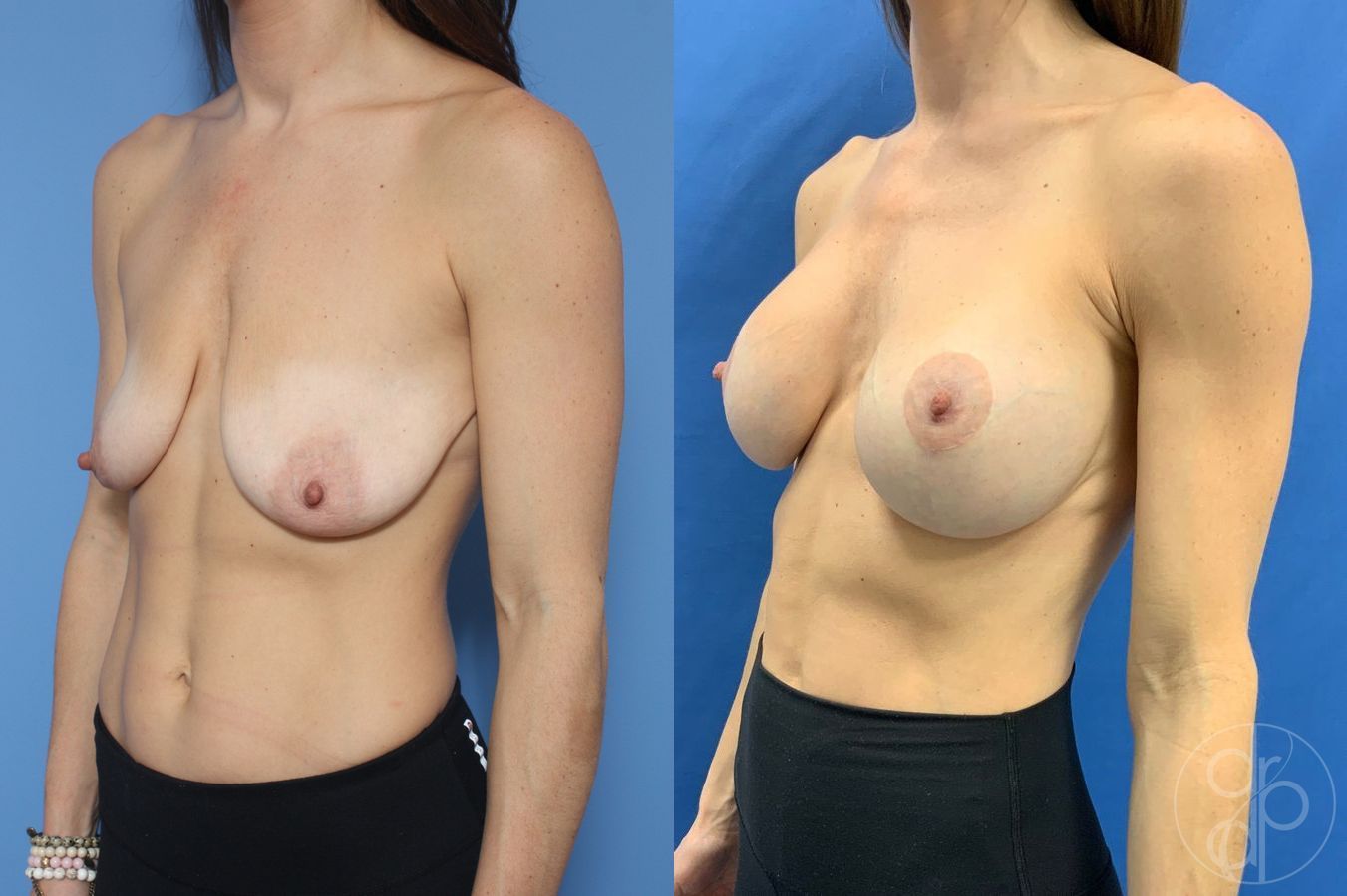 Breast Augmentation with Lift - Thumbnail 3