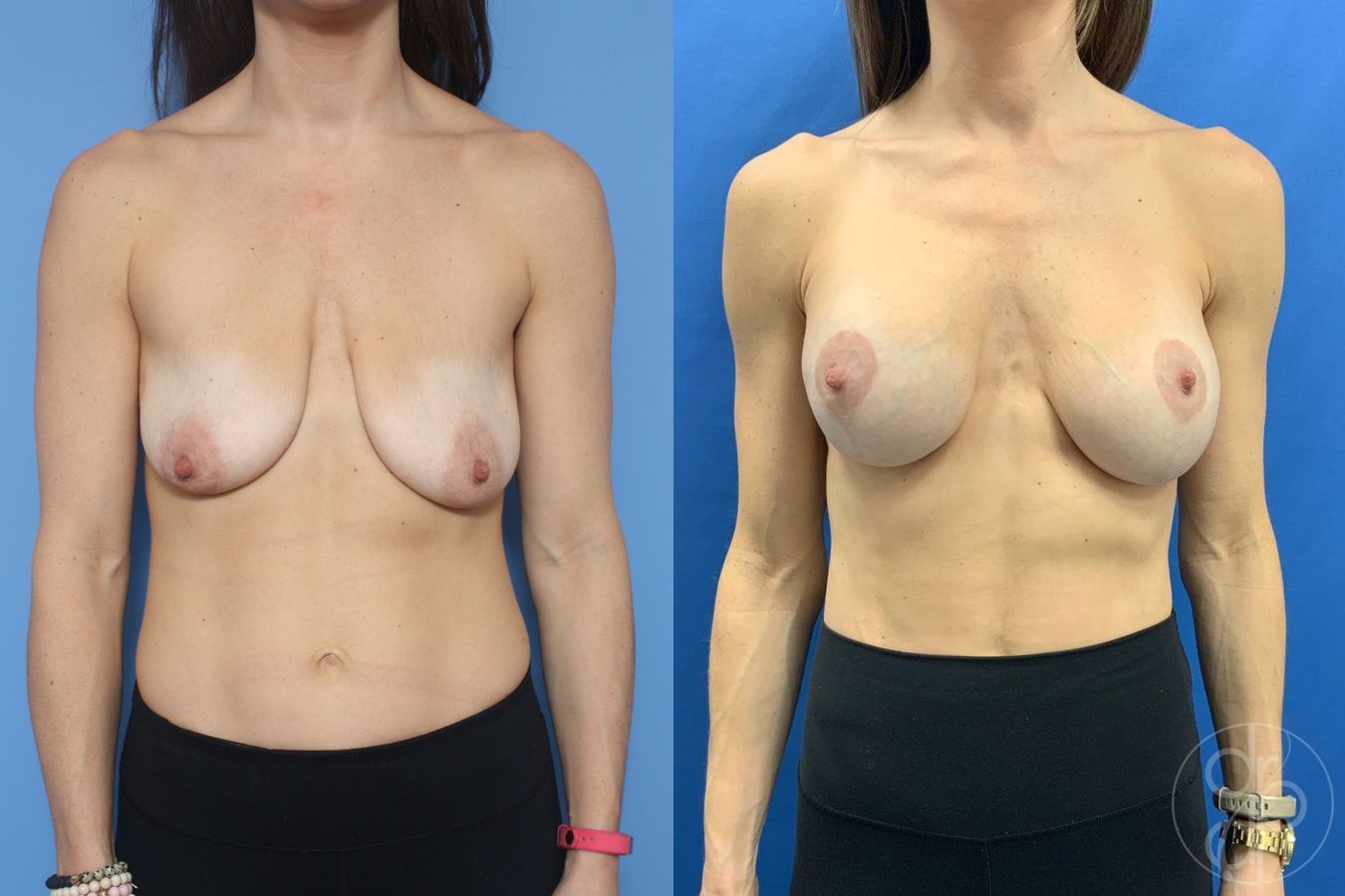 Breast Augmentation with Lift - Case 476