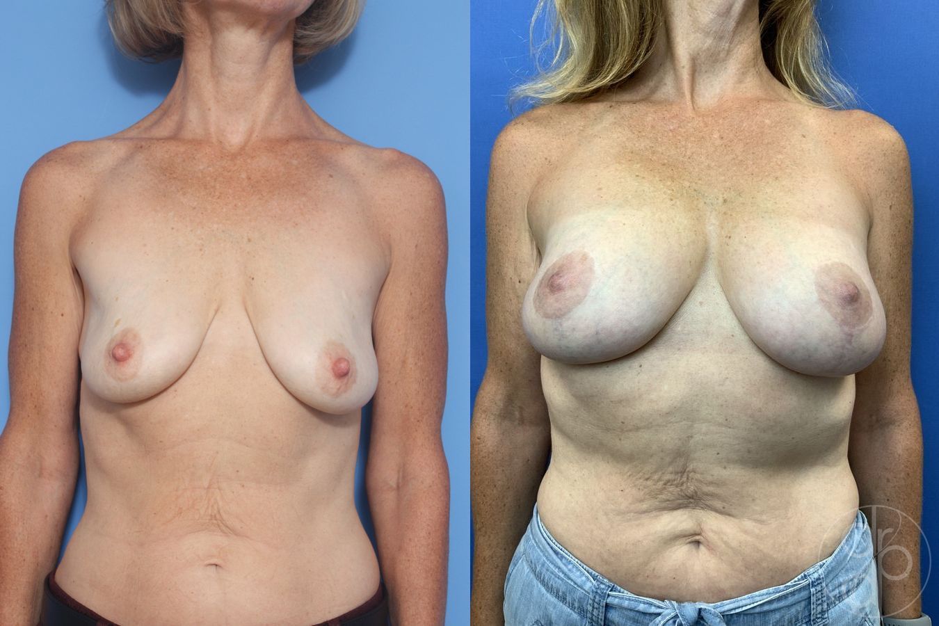 Breast Augmentation with Lift - Case 474