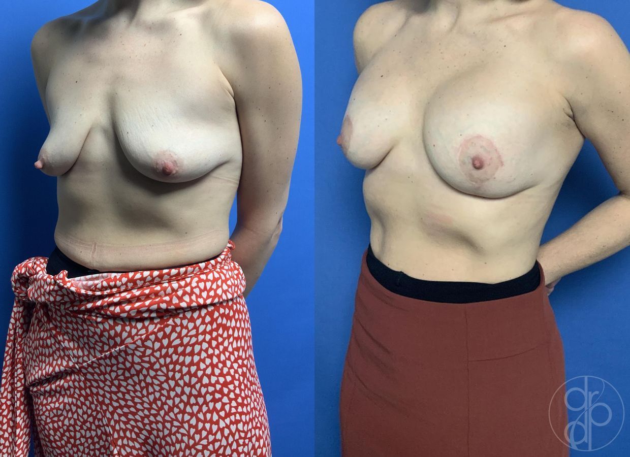 Before and after Breast Augmentation with Lift case 29799 - Angle 3